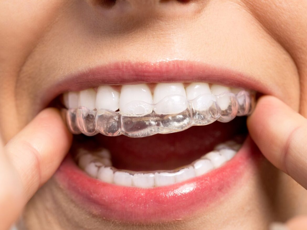 Straighten Your Teeth Seamlessly with a Free Invisalign Dentist Appointment